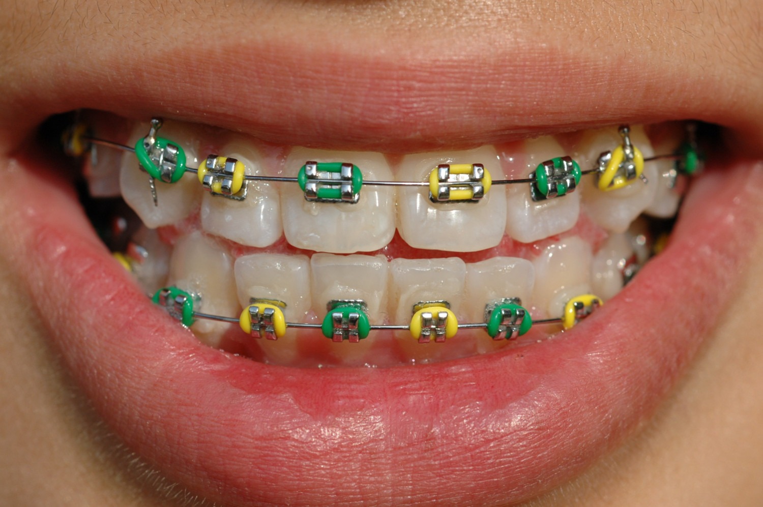 Green and yellow braces