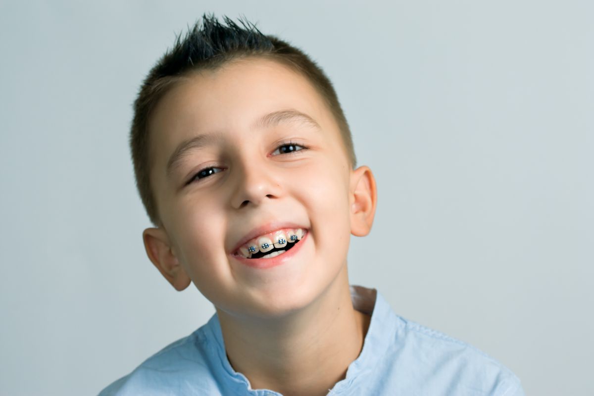 Everything You Need to Know About Palatal Expanders