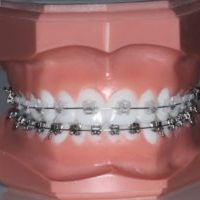 Model of clear braces